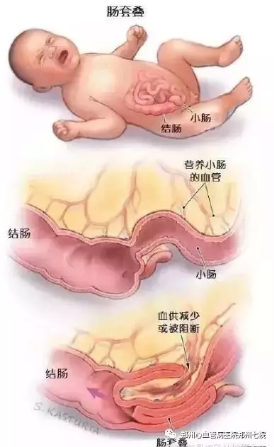 什么原因导致的肠梗阻 20190430160513_2597.jpg