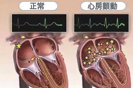 房颤不重视 后果很严重