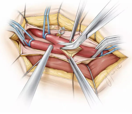颈内动脉支架置入术后再狭窄之内膜切除术